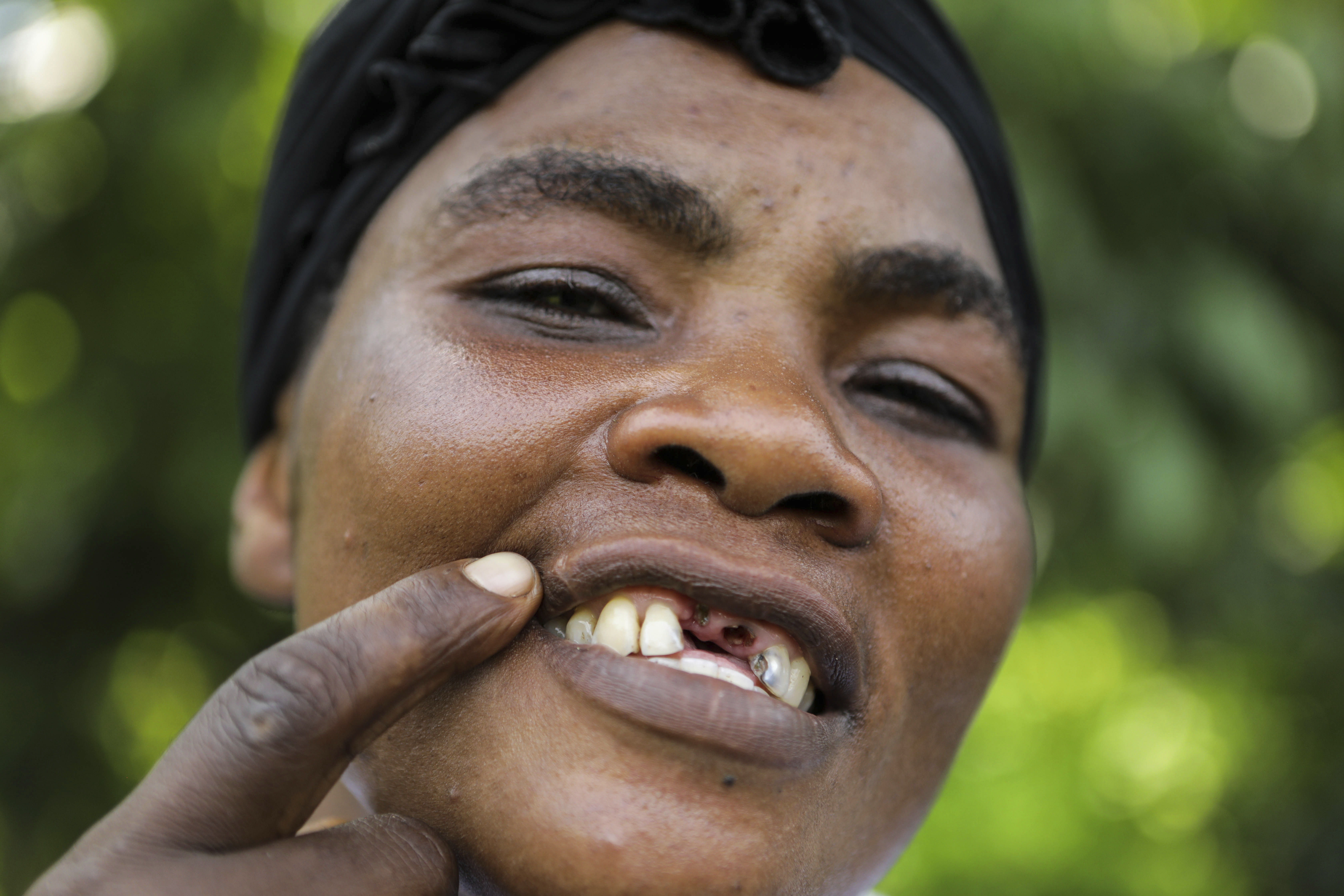 Christine Kalungi, a victim of gender domestic violence shows a scar on her lip and missing teeth in Bundibugyo district, Western Uganda, Sunday, June 30, 2024.<br />(Hajarah Nalwadda / AP Photo)