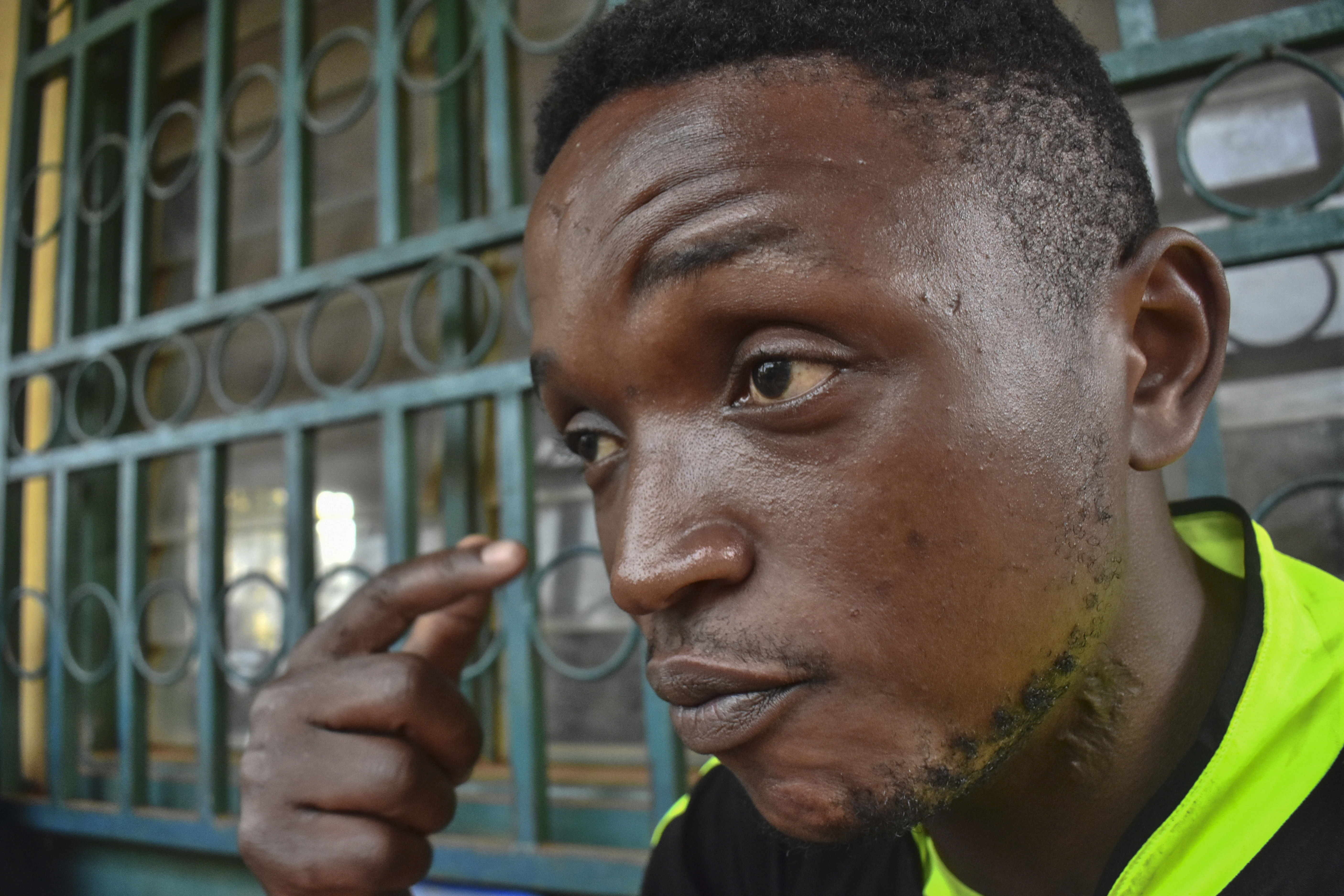 Ateasong Belts Tajoah shows a bullet scar on his neck during an interview with The Associated Press in Dschang, Cameroon, Friday, Dec. 1, 2024.<br />(Robert Bociaga / AP Photo)